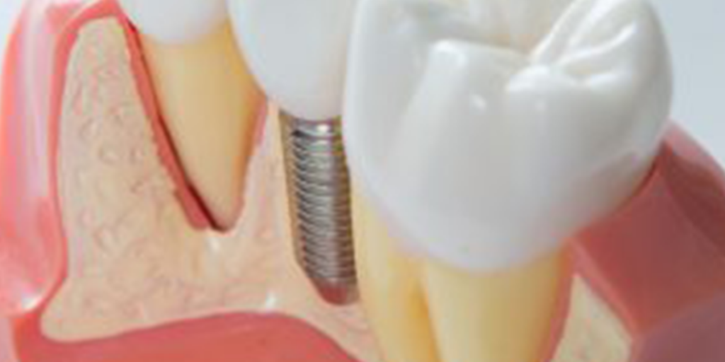 Зуб без кости. Возмещение утраченного зуба композитным материалом. Smart graft аппарат.