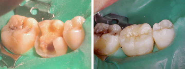 odontoiatria-coservativa-indiretta
